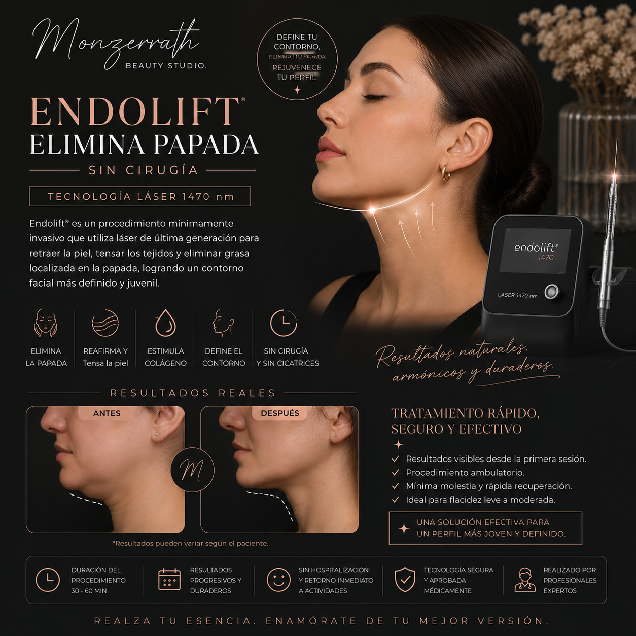 Endolift (Full face incluye mejillas surcos ) (copia)